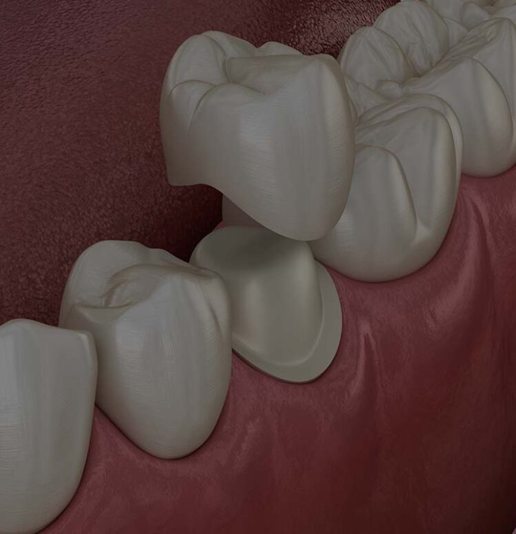 Treatment - Toothcare dental