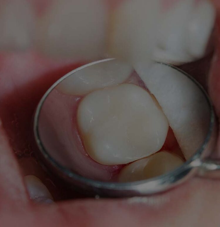 Treatment - Toothcare dental